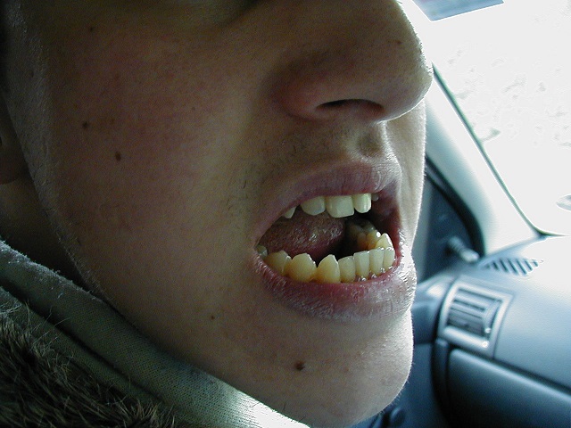Alex teeth 1 (2).jpg