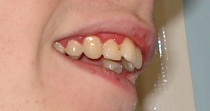 Ash teeth 2.jpg