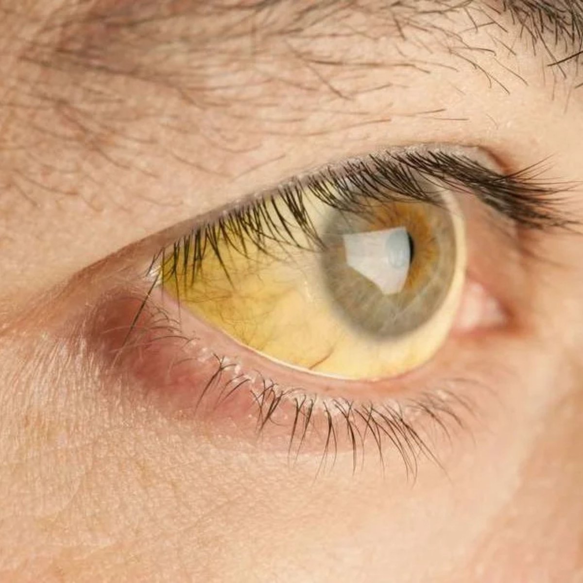 Yellowish Discoloration -Online Doctor Consultation in Pune.jpg