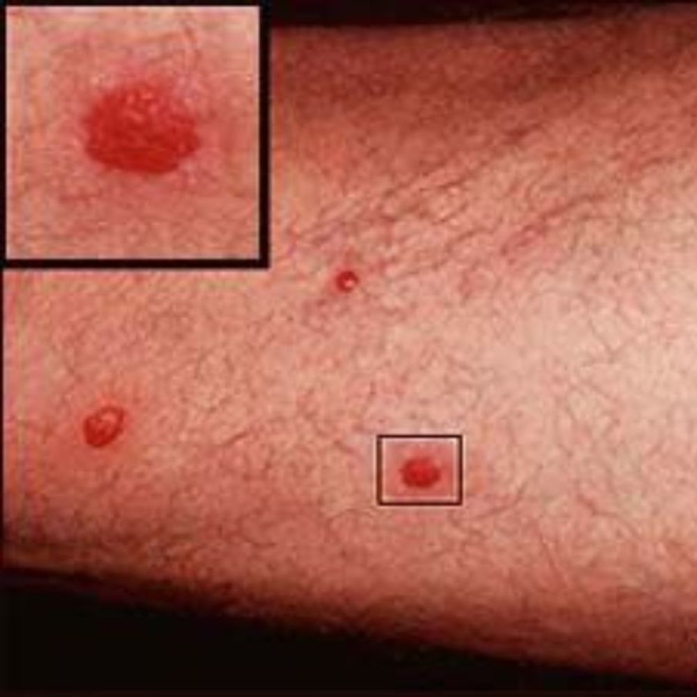 Red, Circular Patches on Skin - Online Doctor Consultation in Pu